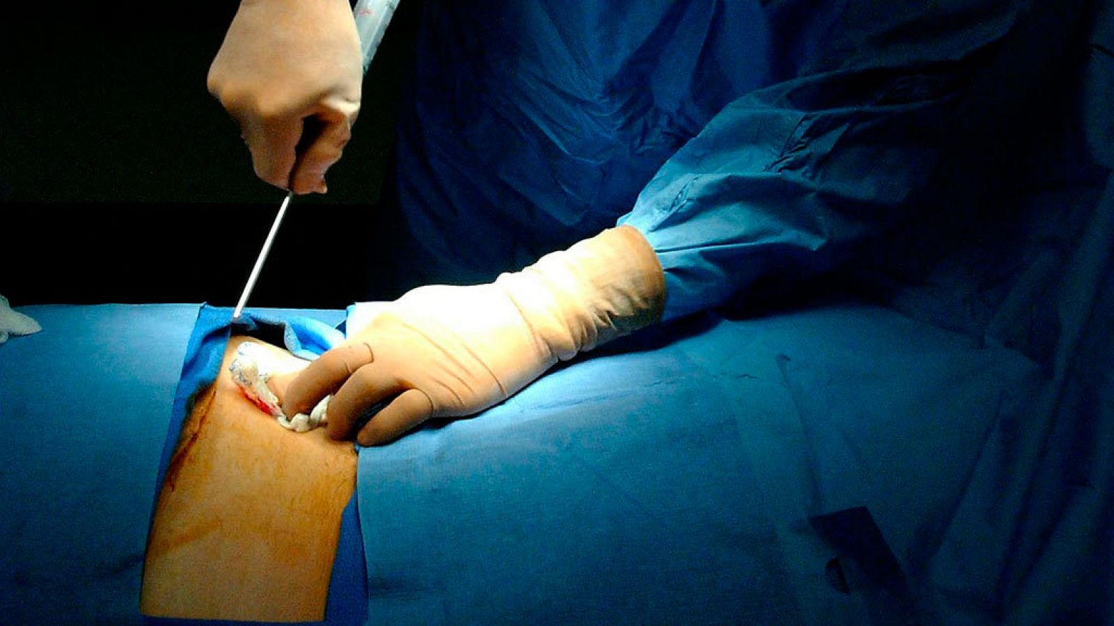 La probabilidad de encontrar un donante de médula ósea en España sube al 90%