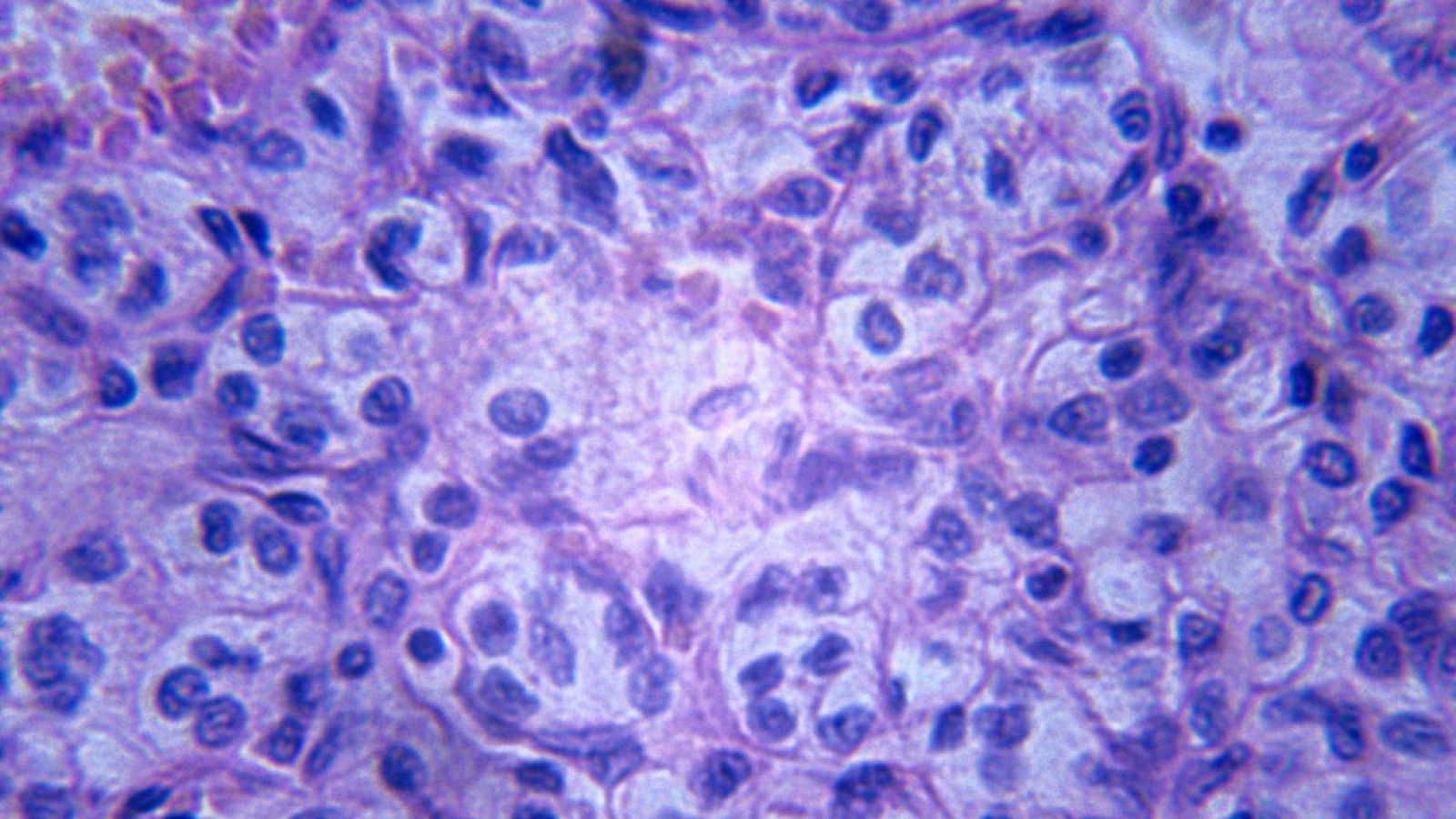 Así continúa la investigación en la lucha contra el cáncer