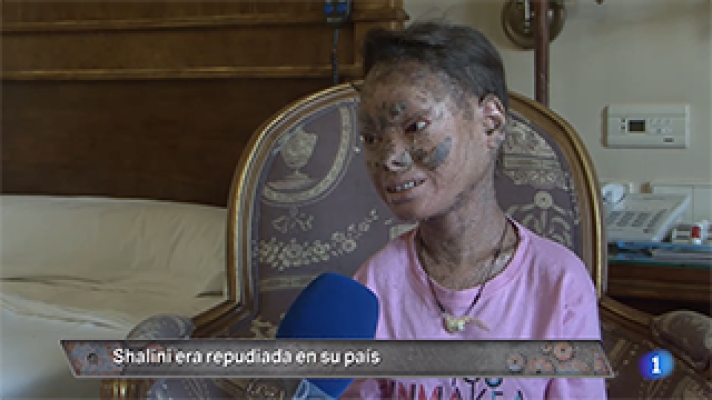 Hora punta - No os perdáis el caso de Shalini, la llamada "niña serpiente". La entrevistamos en EXCLUSIVA y lo debatimos con los doctores que han tratado a la joven