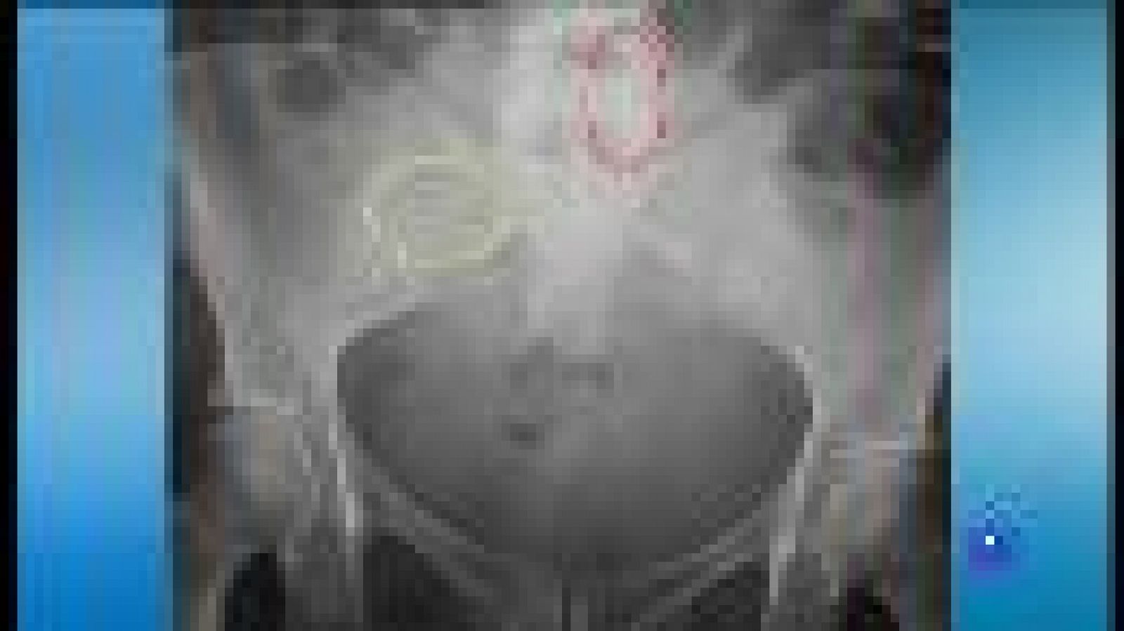 Demanda col·lectiva per l'Essure