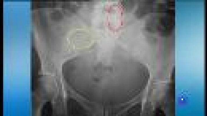 Informatiu Balear - Demanda col·lectiva per l'Essure