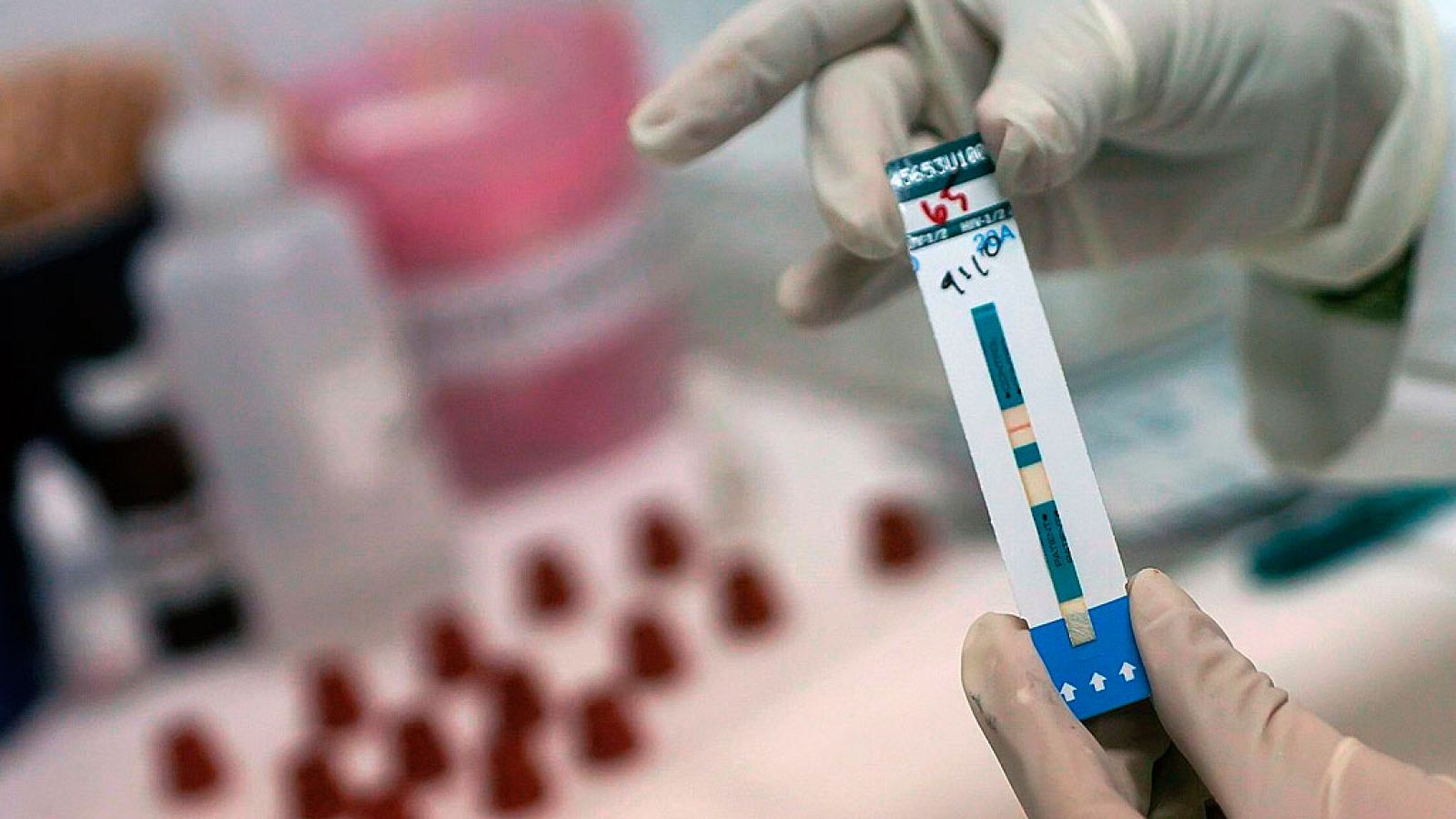 El diagnótico temprano del VIH fundamental para la calidad de vida de los pacientes - La 2 Noticias | Ver