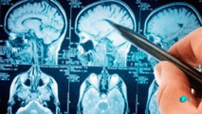 ¿Podrían curarse las enfermedades neurodegenerativas?