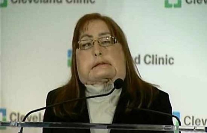 Connie Culp es la cuarta persona del mundo en someterse a un trasplante de cara.  El hospital estadounidense de Cleveland (Ohio) ha presentado a esta paciente a la que han cambiado el 80% de su rostro tras realizarle más de 30 operaciones despues de que, según ha contado la propia Culp, su marido le disparase en la cara tras una discusión en 2004 (05/05/09).