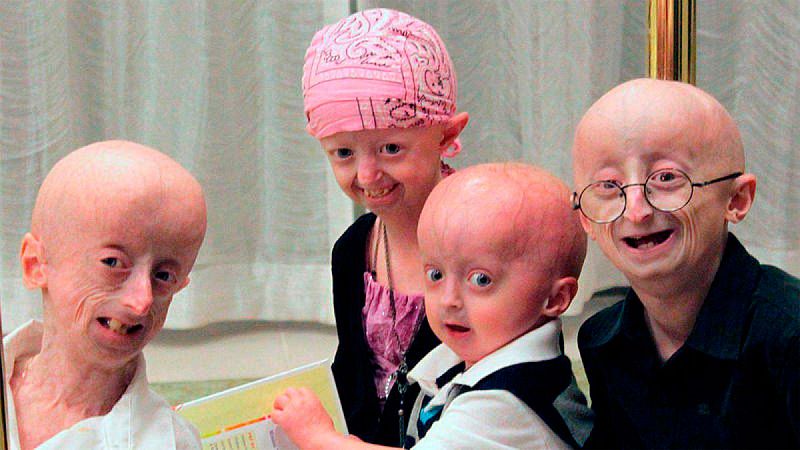 El síndrome de progeria de envejecimiento acelerado Hutchinson-Gilford es una enfermedad rara que aparece en la infancia, acelera el envejecimiento y causa la muerte prematura. Ahora, dos estudios desarrollados en ratones y basados en la edición gené