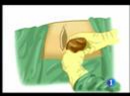  - Trasplante mediante laparoscopia