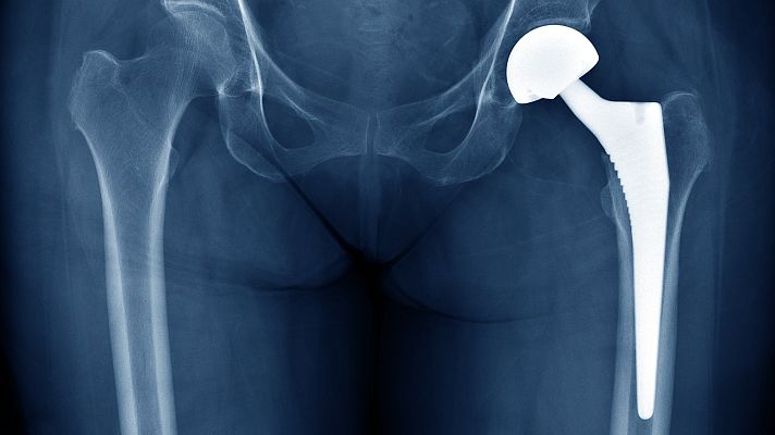 Telediario 1 - La Audiencia Nacional investiga a Johnson & Johnson por prótesis de cadera defectuosas