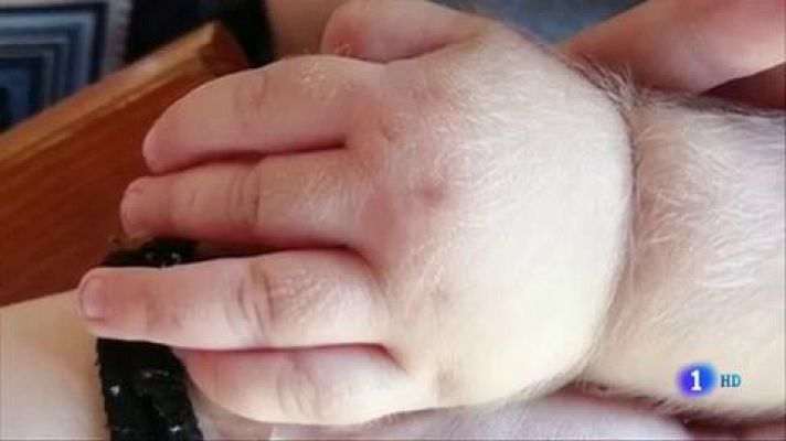 Telediario 1 - Al menos 17 bebés afectados por omeprazol contaminado que les provoca exceso de vello