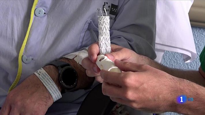 El Marañón, pionero al imprimir en 3D una prótesis de aorta