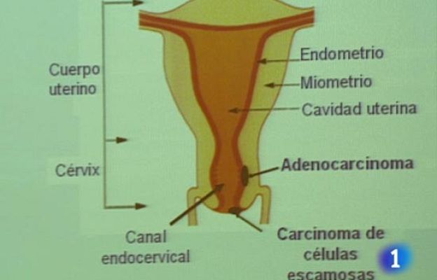 Ciencia y tecnología en Rtve.es - Vacuna contra el papiloma humano