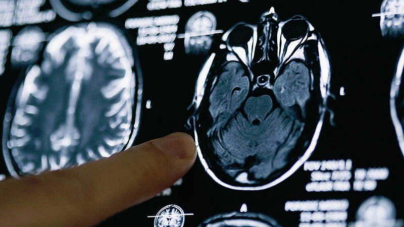 Investigadores españoles demuestran que un anticoagulante oral retrasa la aparición del alzhéimer