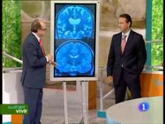 Infartos en el cerebro