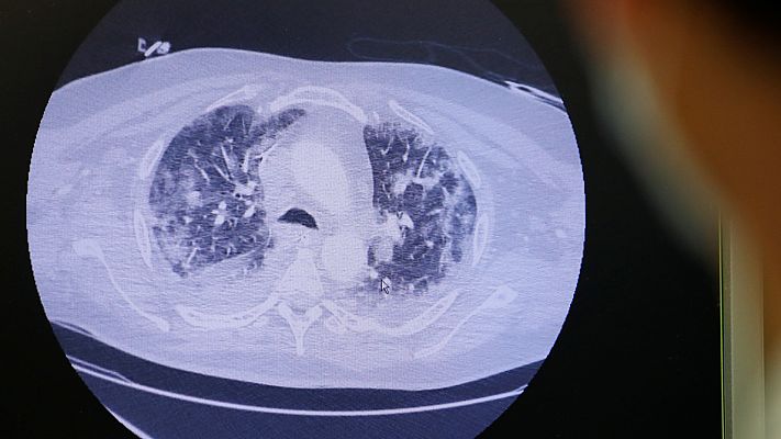 Telediario 1 - En Francia revisan pruebas que podrían indicar que ya hubo casos de coronavirus a mediados de noviembre