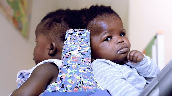 Separan con éxito a dos siamesas unidas por la cabeza