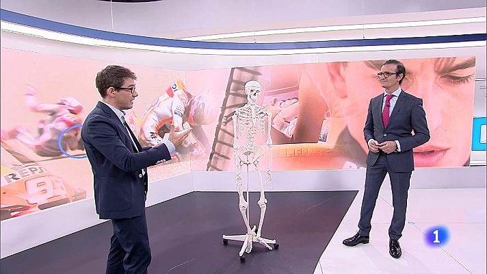 Telediario 1 - El doctor Villamor explica a TVE la intervención a Marc Márquez