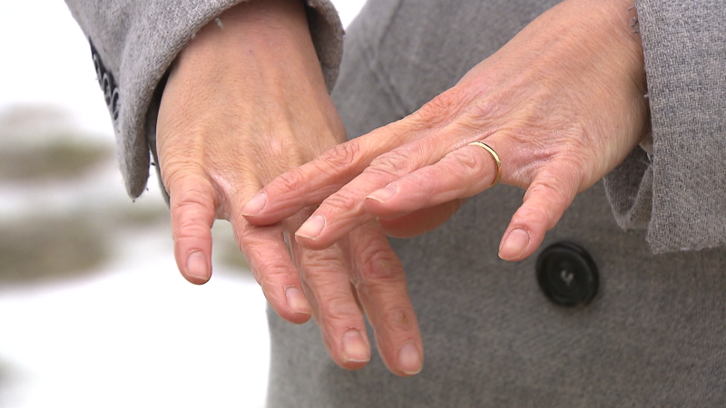 La dermatitis atópica y el frío 