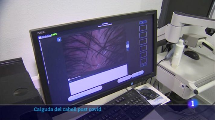 L'Informatiu - Un 25% dels malalts de covid pateix efluvi telogènic