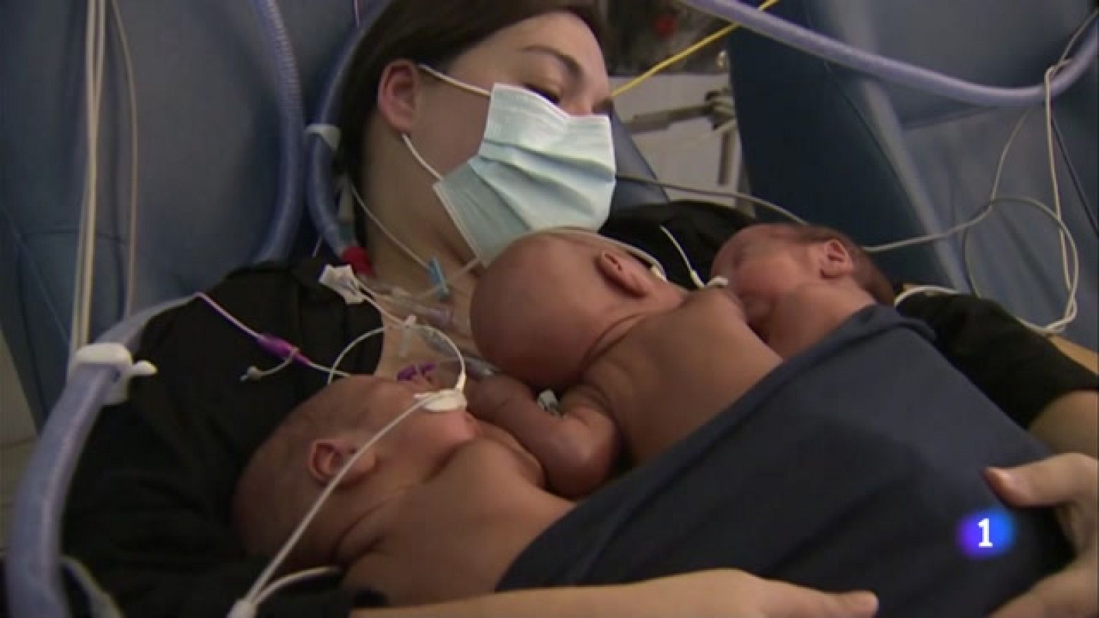 Vall d'Hebron aconsegueix que una mare faci mètode cangur amb els seus trigèmins prematurs