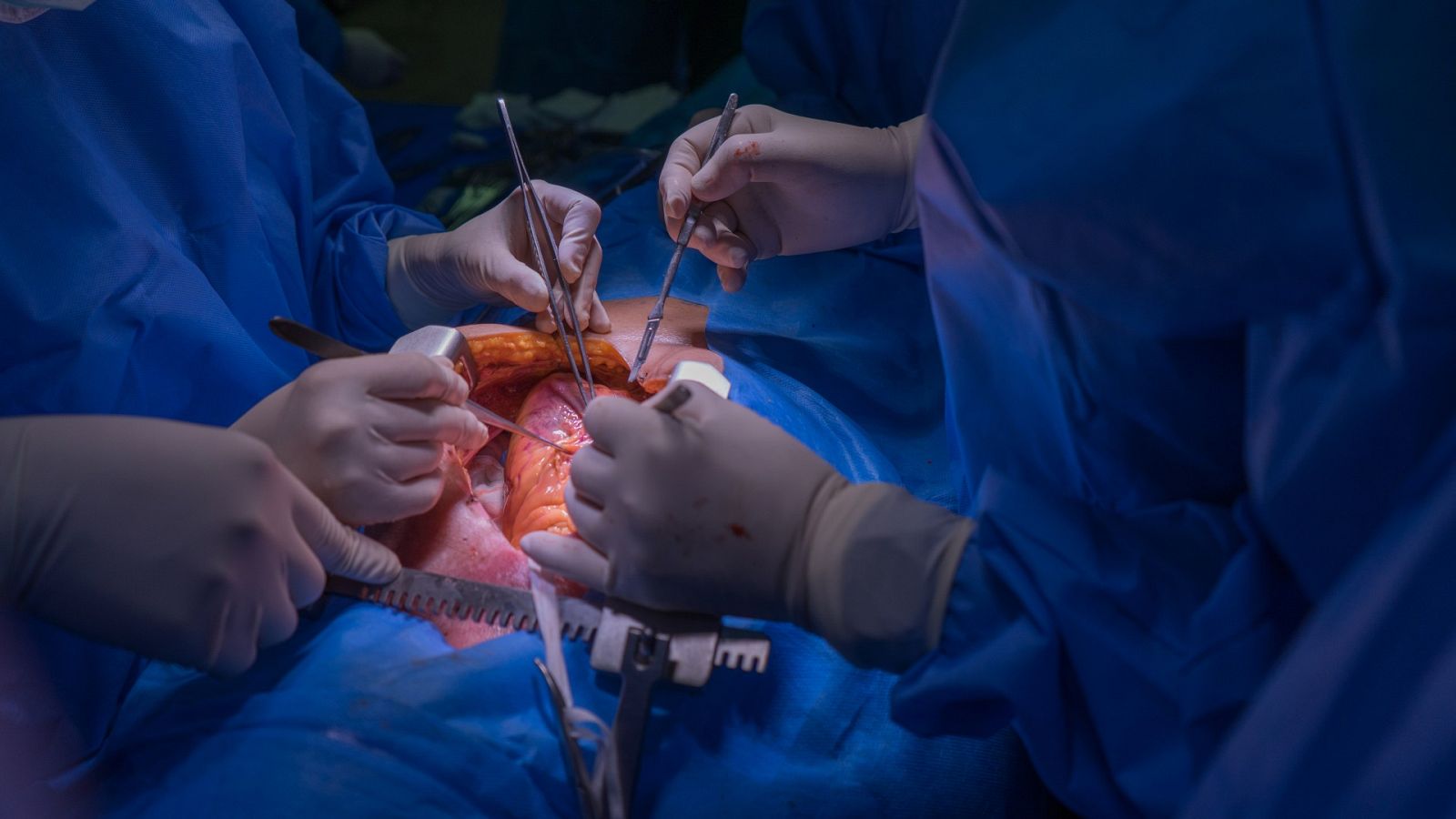 Realizan el primer transplante de corazón en Esapaña con un sistema que lo mantiene recibiendo sangre oxigenada permanentemente