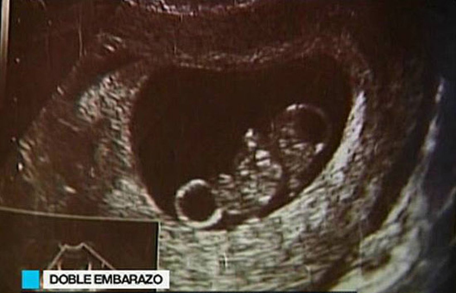 Se queda embarazada estando embarazada