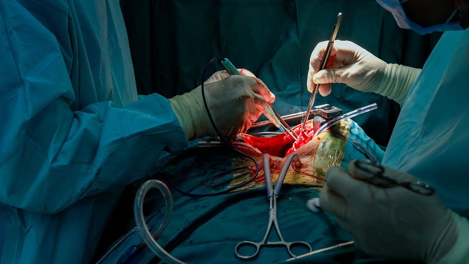 Primer trasplante pulmonar a un paciente COVID en España - Informativo 24h | Ver