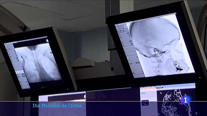 L'Informatiu - L'ictus és la segona causa de mort arreu del món