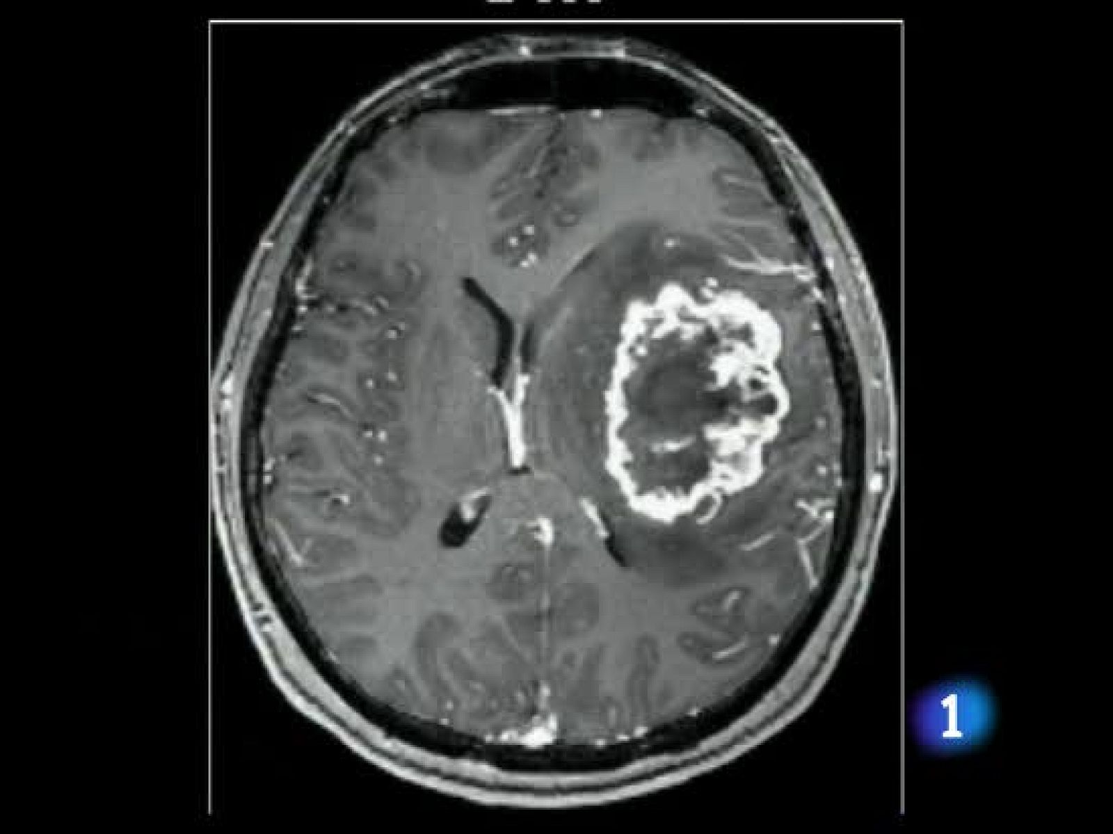 Comienzan los ensayos clínicos para tratar el tumor cerebral más agresivo