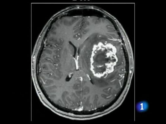 Vacuna contra el tumor cerebral