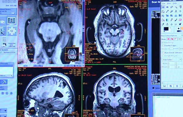 Ciencia y tecnología en Rtve.es - Nuevos avances sobre el Alzheimer