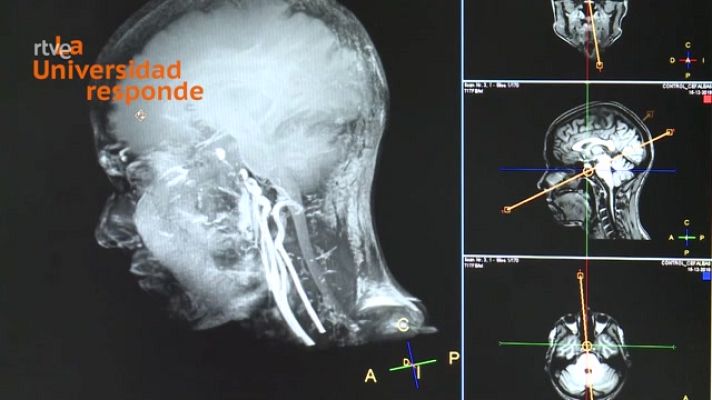 La aventura del Saber - ¿Es peligroso hacerse una resonancia magnética?