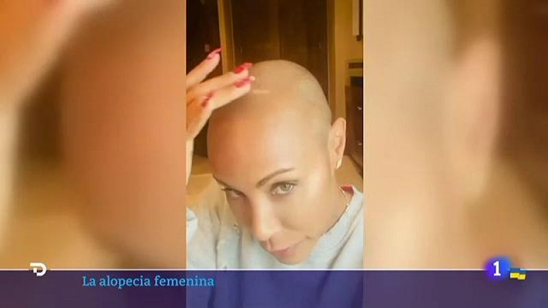 La agresi�n de Will Smith a Chris Rock en los Oscar�tambi�n pone el foco en la alopecia femenina