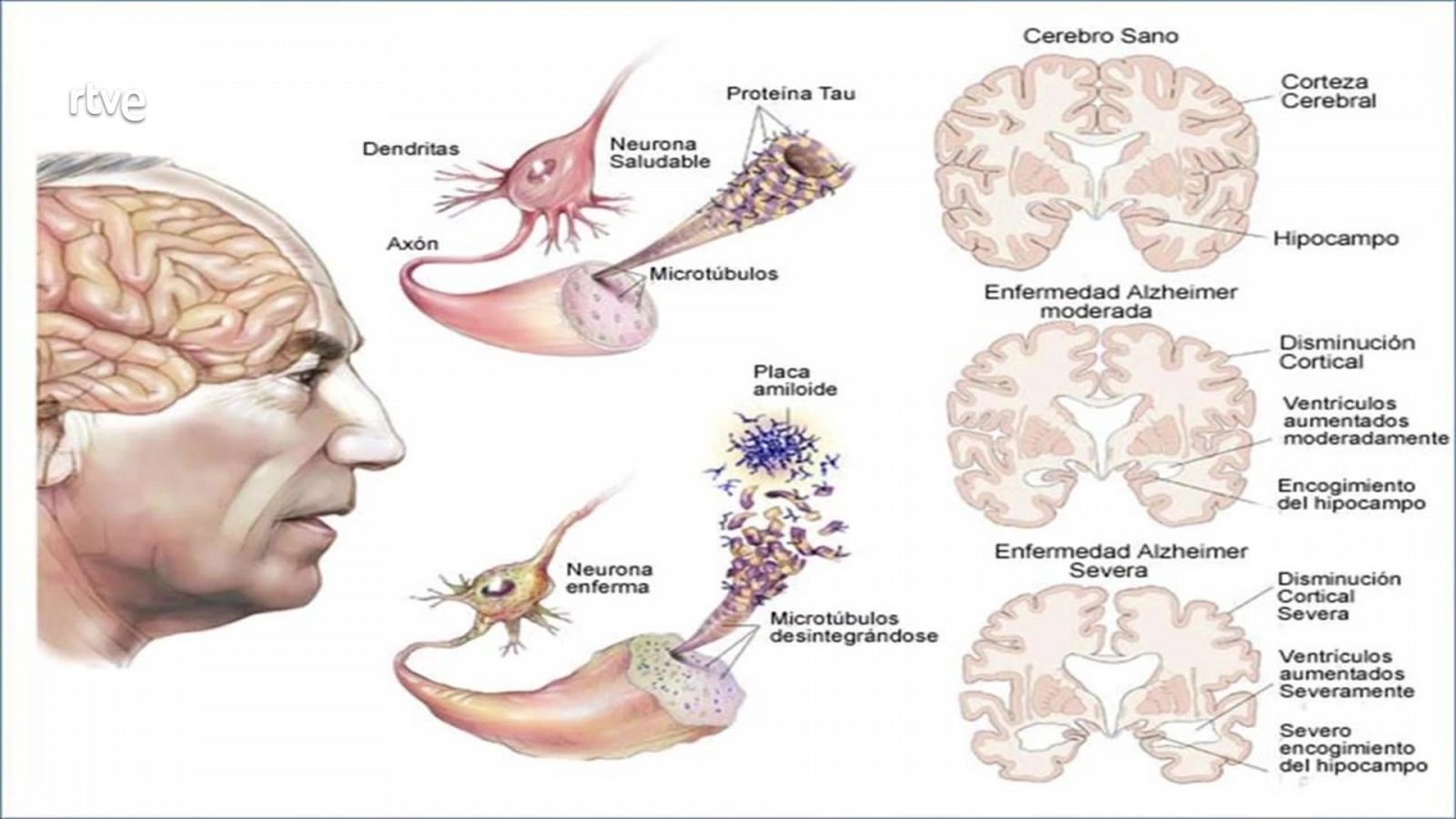 ¿Podrán curarse las enfermedades neurodegenerativas en un futuro? 