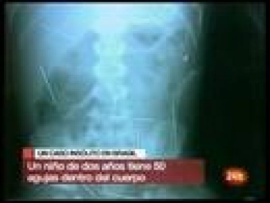  - Niño tiene 50 agujas en su cuerpo