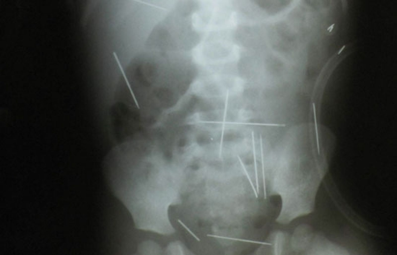 El médico que lo trata ha dicho que intentará sacárselas pero que es difícil porque algunas están demasiado cerca de órganos vitales.