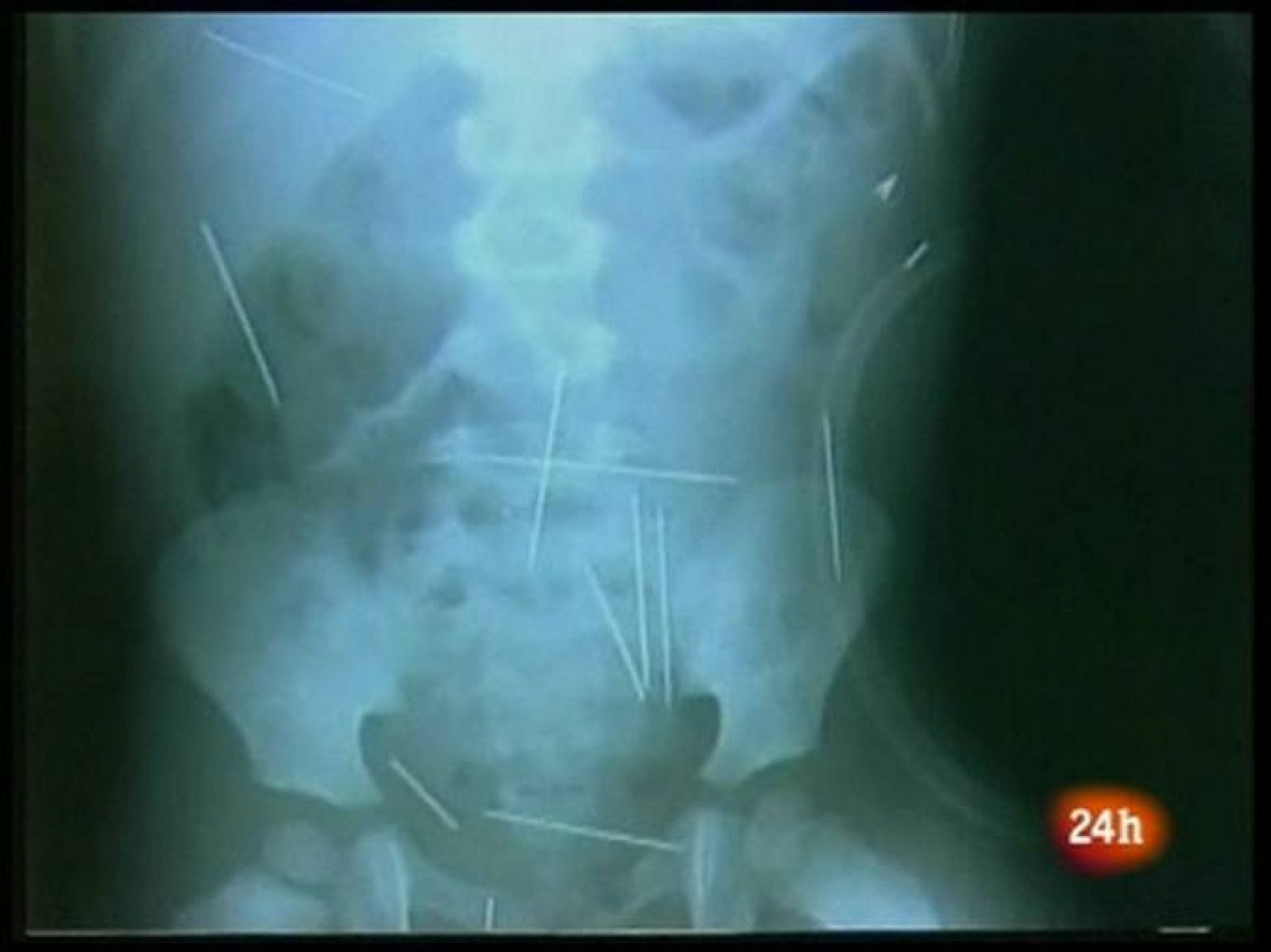 El niño con agujas en el cuerpo, víctima de un ritual