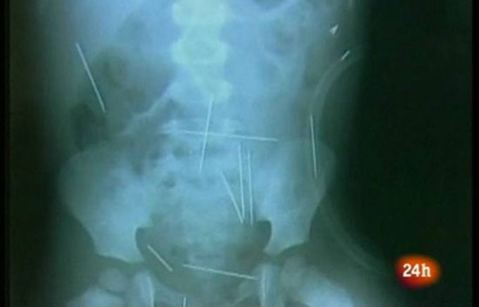 El niño con agujas en el cuerpo, víctima de un ritual