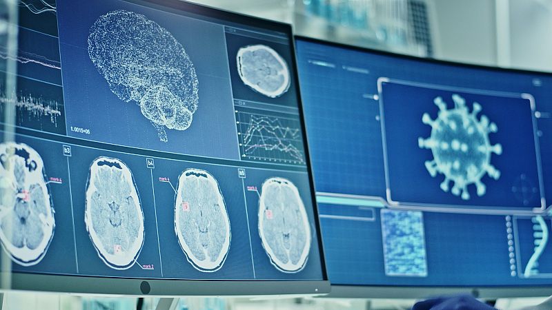 El COVID-19 grave puede envejecer el cerebro, según un estudio de la Universidad de Cambridge