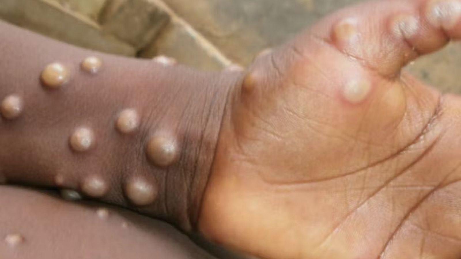 Detectan en Madrid ocho posibles casos de viruela del mono | Ver