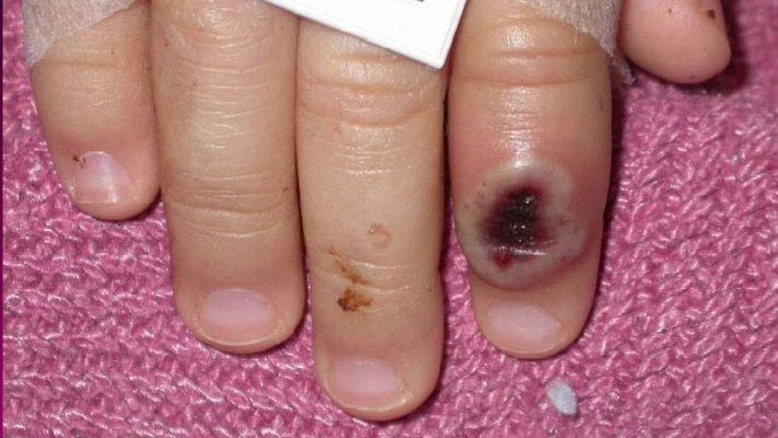 Telediario 2 - Canarias confirma el primer contagiado por viruela del mono y son ya 36 casos en España