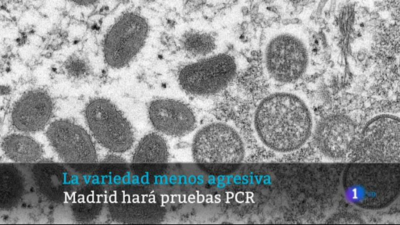  el brote de la viruela del mono que afecta a España es el de menor virulencia de los conocidos. Hay 84 positivos, 51 en la Comunidad. (COLAS) Madrid comenzará desde este fin de semana a realizar PCR en 5 hospitales para confirmar posibles casos ante