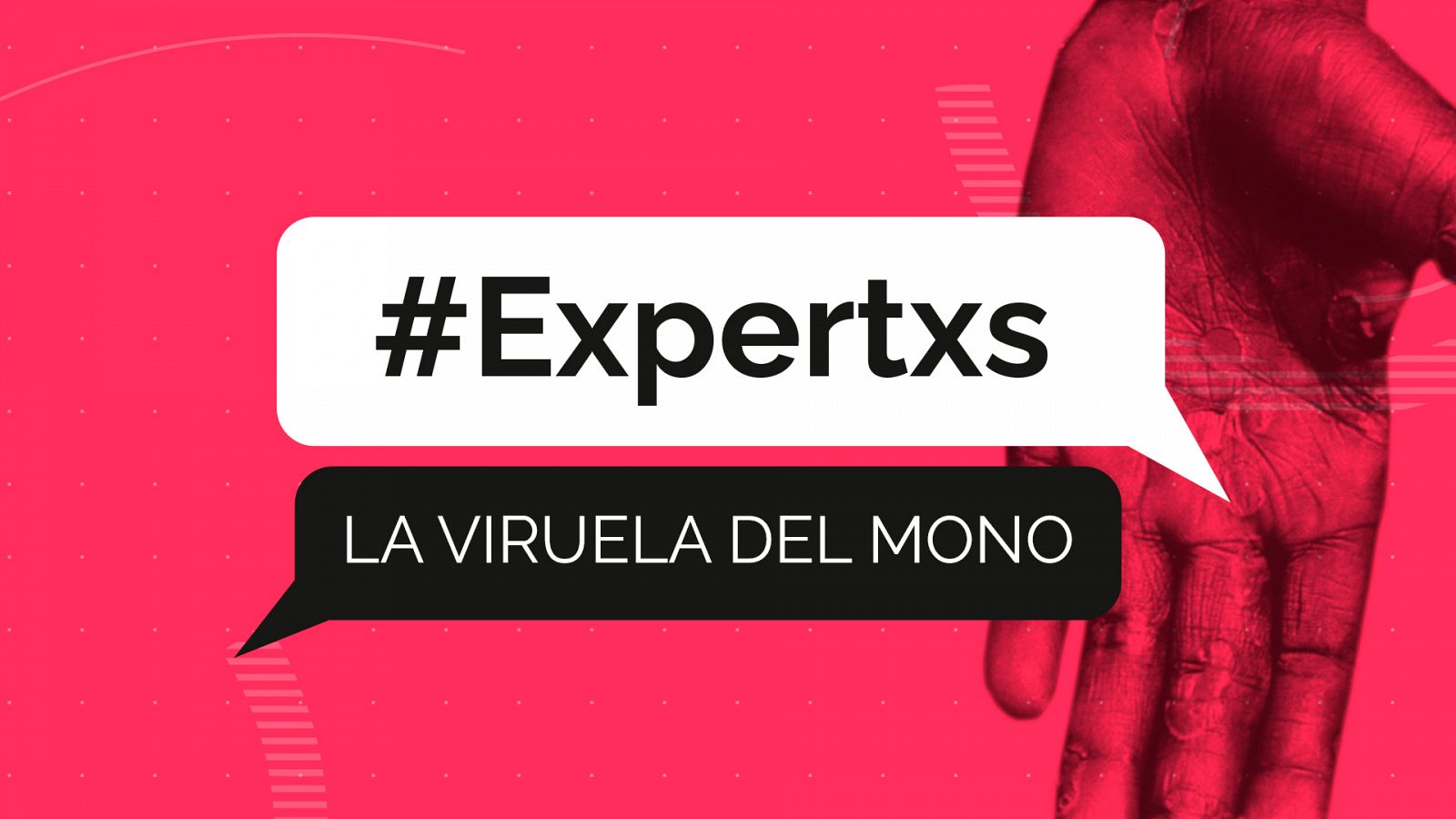 Expertxs | La viruela del mono y sus estigmas - RTVE.es