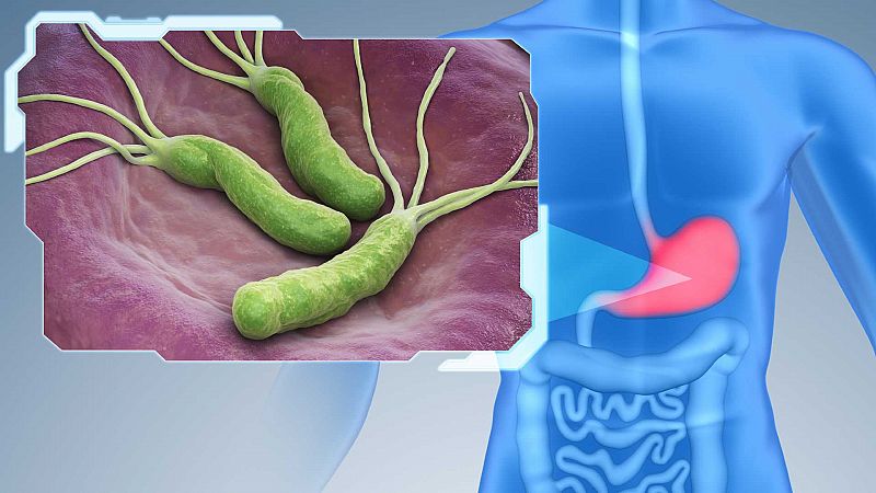Cómo ayudar al estómago con la bacteria Helicobacter Pylori