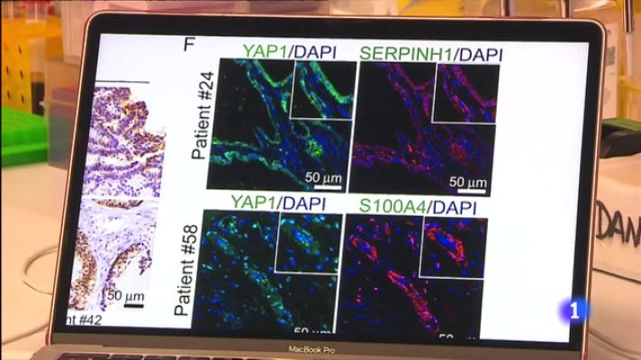 L'Informatiu - Identifiquen els gens que sobreviuen a la quimioteràpia del càncer de còlon
