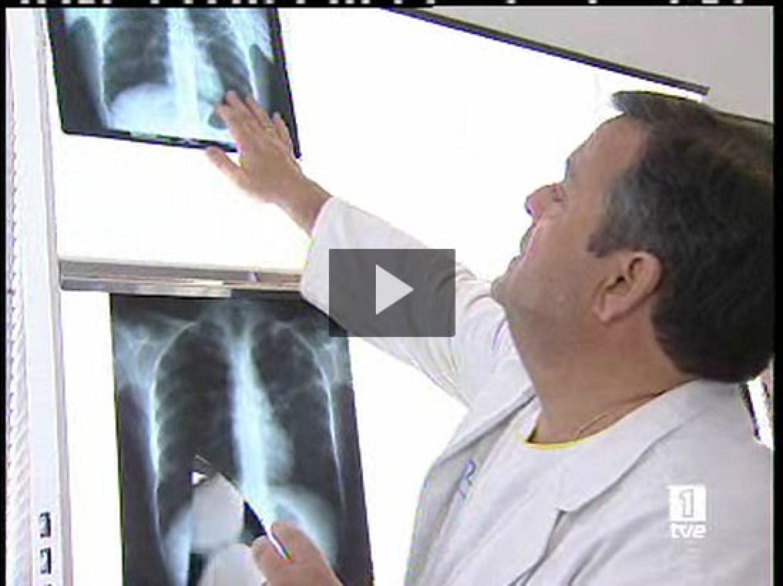  El coste del asma en España es superior al del sida y la tuberculosis juntos. Lo dice un estudio que se ha conocido hoy, día mundial del Asma. Más de tres millones de personas sufren esta enfermedad en nuestro país.