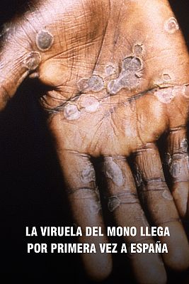 Confirmada la primera muerte por viruela del mono en España