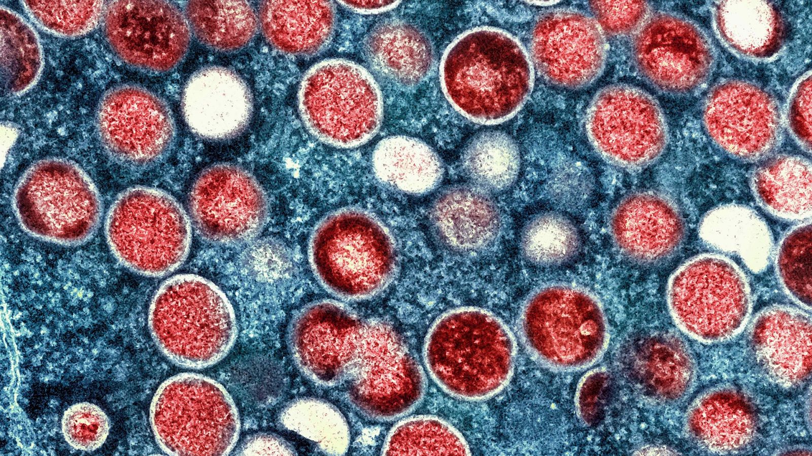 Un 40 % de los pacientes con viruela del mono tienen complicaciones dolorosas que requieren tratamiento médico