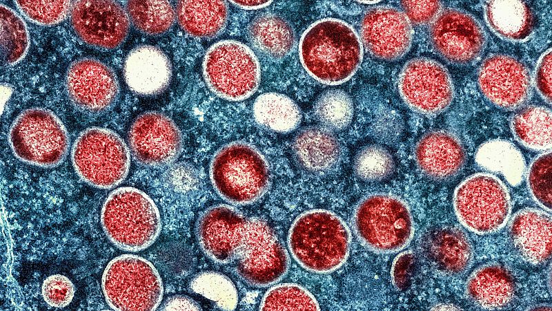Un 40 % de los pacientes con viruela del mono tienen complicaciones dolorosas que requieren tratamiento médico