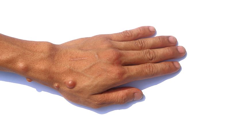 La doble estigmatización de las personas con neurofibromatosis con la irrupción de la viruela del mono