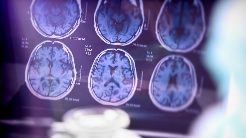Investigación y detección precoz, claves en el futuro del alzhéimer