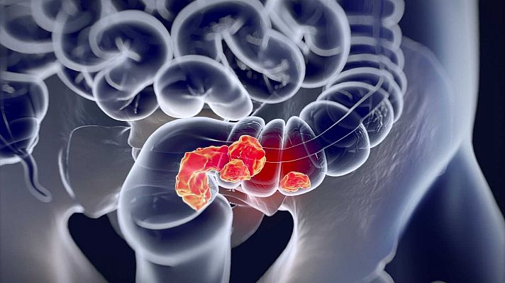 Identifican las células responsables de la recaída en el cáncer de colon